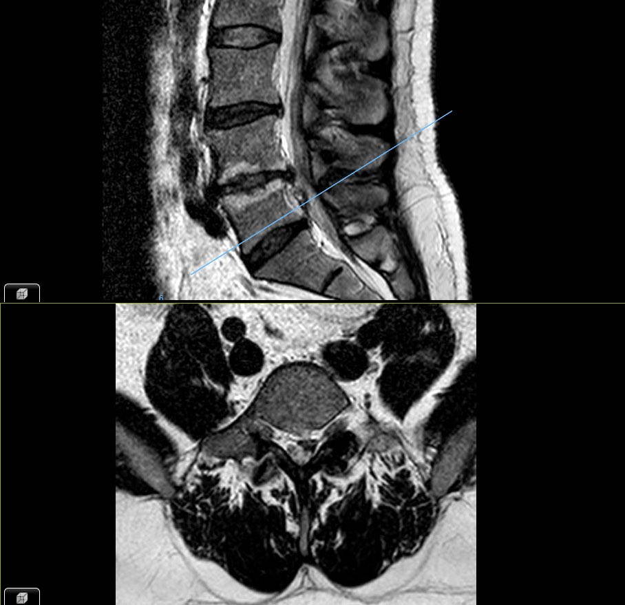 Muchas hernias de disco lumbares se reabsorben, aquí un paciente con 2 resonancias realizadas en 18 meses.
En un artículo reciente pubmed.ncbi.nlm.nih.gov/37559207 la tasa de resorción varía, 88% en secuestros pero 38% en protrusiones.
No operamos RM, se opera la clínica del paciente.
