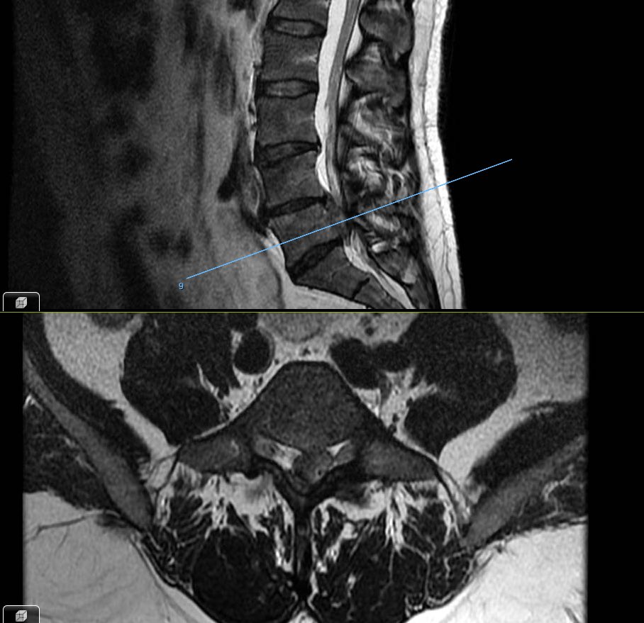 ojedathies's tweet photo. Muchas hernias de disco lumbares se reabsorben, aquí un paciente con 2 resonancias realizadas en 18 meses.
En un artículo reciente https://t.co/8SqsnjoJQ1 la tasa de resorción varía, 88% en secuestros pero 38% en protrusiones.
No operamos RM, se opera la clínica del paciente. https://t.co/8k1yGTjRRJ