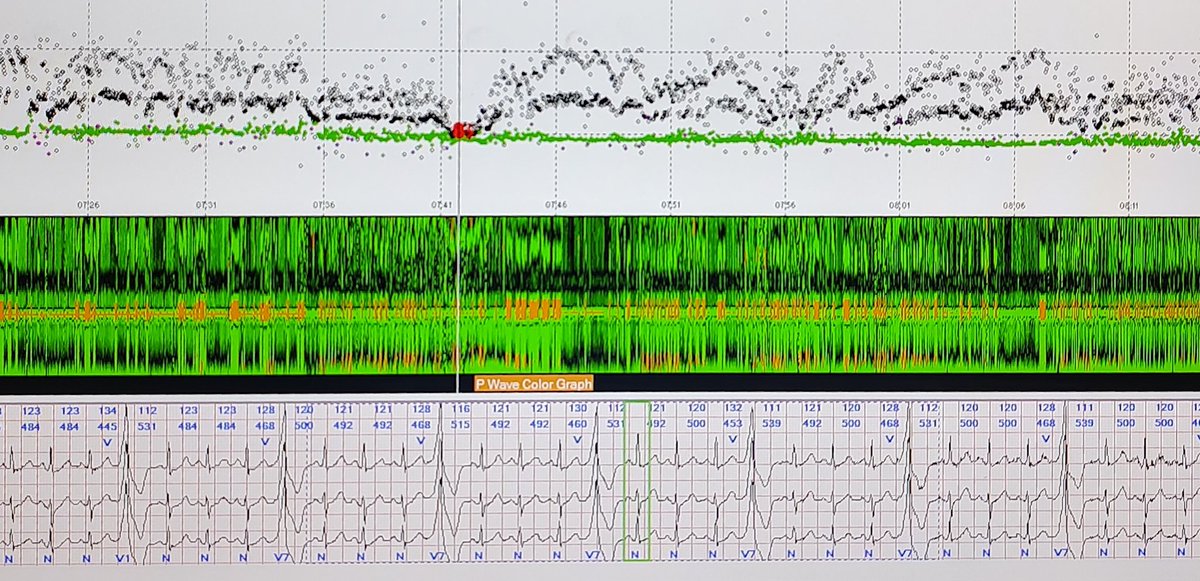 Fixed coupling interval of VEs about 460 msec as green line. When sinus accelerates (the second pic) VEs come at about the rate of P waves. Sometimes VEs may start inadvertently from P wave and mimic intermittent WPW. But longer recording reveals there's no preexcitation.