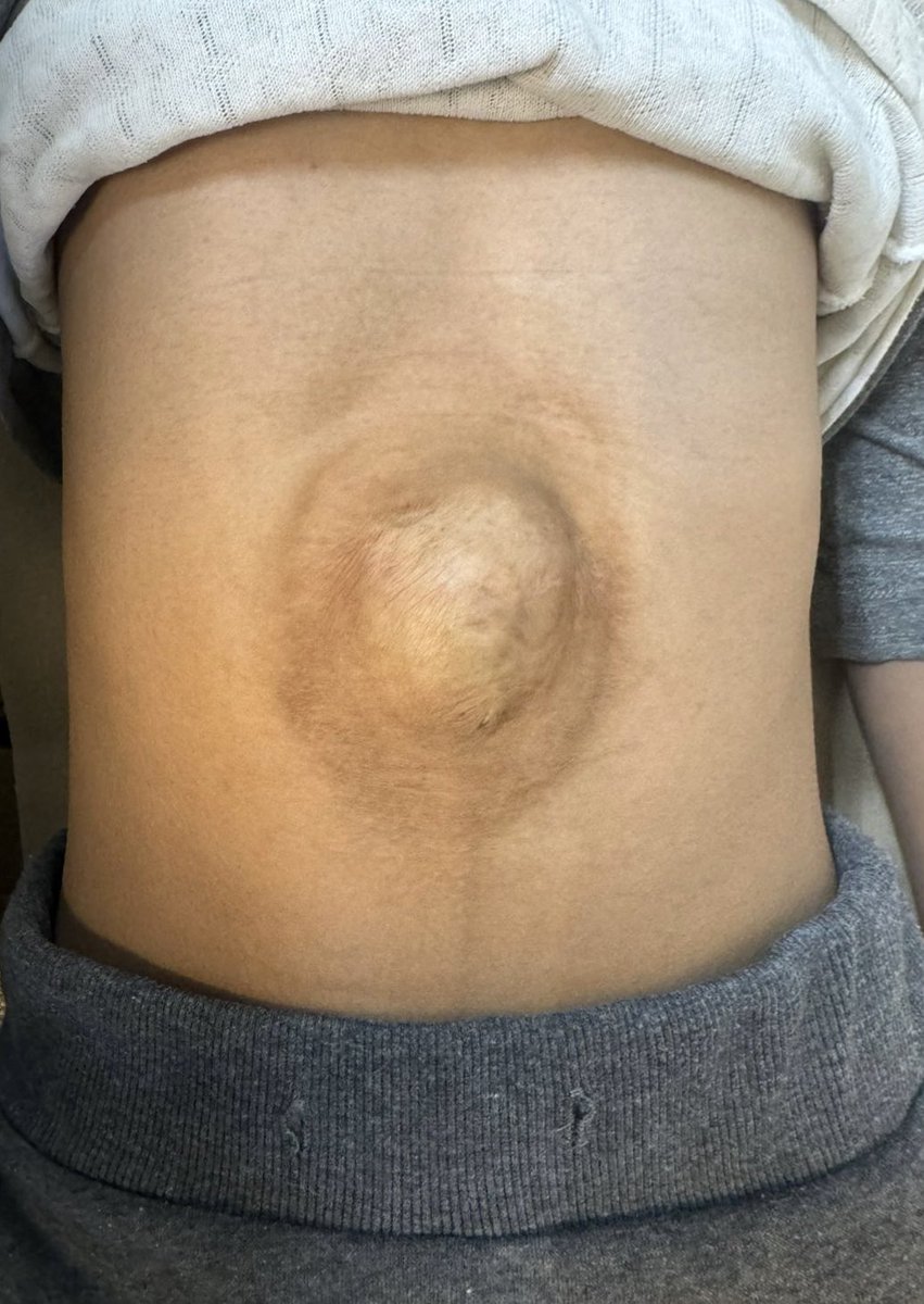 RicardoRGlz's tweet photo. Ya estamos haciendo ombligos nuevos 
#LaParedImporta
#HerniaDudeKids https://t.co/81wX4OAogv
