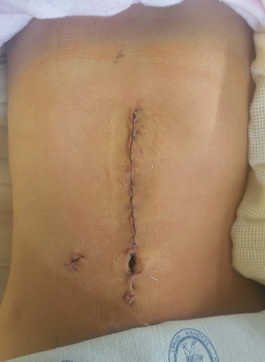 Ya estamos haciendo ombligos nuevos 
#LaParedImporta
#HerniaDudeKids