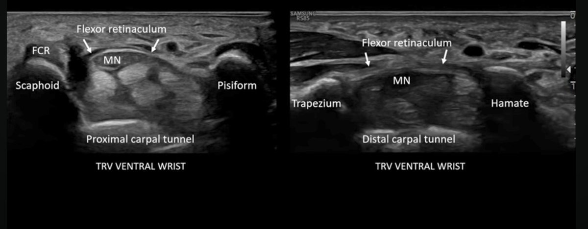 الفرق بين
Proximal carpal tunnel &amp; distal carpal tunnel
تعلم معنا في MSKUS