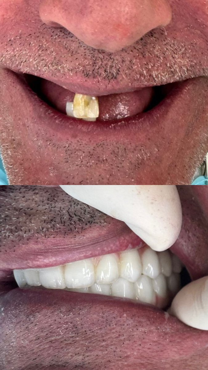 Before &amp; After 
Full mouth rehabilitation by implant supported fixed prosthesis 

Now the patient smile back to life 🤍

تم اعادة تأهيل كاملة للفم وتركيب اسنان ثابتة من الزركون على 6 زرعات في الفك العلوي و 6 زرعات في الفك السفلي