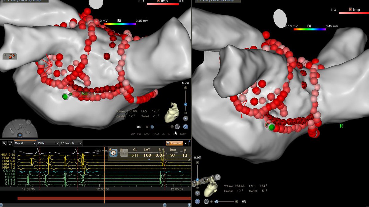 Hakeem Ayinde (@naijaqrs) on Twitter photo While #PVI is the foundational empiric Rx for #AF, tailoring therapy by understanding AF mechanism is often useful.
In this #PAF case, #AF organized to AT after PVI, and was terminated on posterior wall. #EPeeps <a href="/AZ_EP_DOC/">AFPanico</a> <a href="/AlexTurinMD/">Alex Turin</a> <a href="/aalahmadmd/">Amin Al-Ahmad, MD</a> <a href="/gglovedx3/">Gina Glover</a> While #PVI is the foundational empiric Rx for #AF, tailoring therapy by understanding AF mechanism is often useful.
In this #PAF case, #AF organized to AT after PVI, and was terminated on posterior wall. #EPeeps <a href="/AZ_EP_DOC/">AFPanico</a> <a href="/AlexTurinMD/">Alex Turin</a> <a href="/aalahmadmd/">Amin Al-Ahmad, MD</a> <a href="/gglovedx3/">Gina Glover</a>