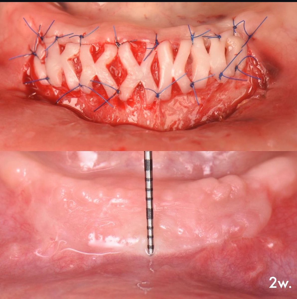 Wael__Talbi's tweet photo. Inspired by techniques in Plastic Surgery 
Alexander De Greef et al. cleverly modified the FGG to expand it up to 70% more of it is original dimensions !! Awesome 👏 https://t.co/ttQ9gslmHO