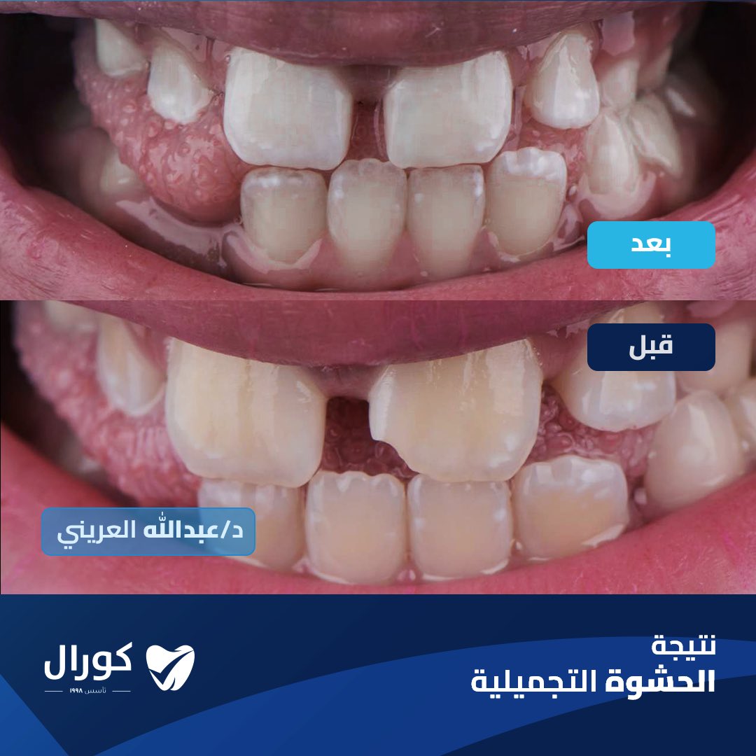 بفضل مهارة وخبرة د. عبد الله العريني، يمكنك الآن الاستمتاع بإبتسامة طبيعية وجميلة مع نتائج مذهلة بعد الحشوة التجميلية.

للحجز أو الاستفسار:
الرقم الموحد: 966920002720+
الواتساب:
wa.me/966112253111

#عيادات_كورال #حشوات_تجميلية