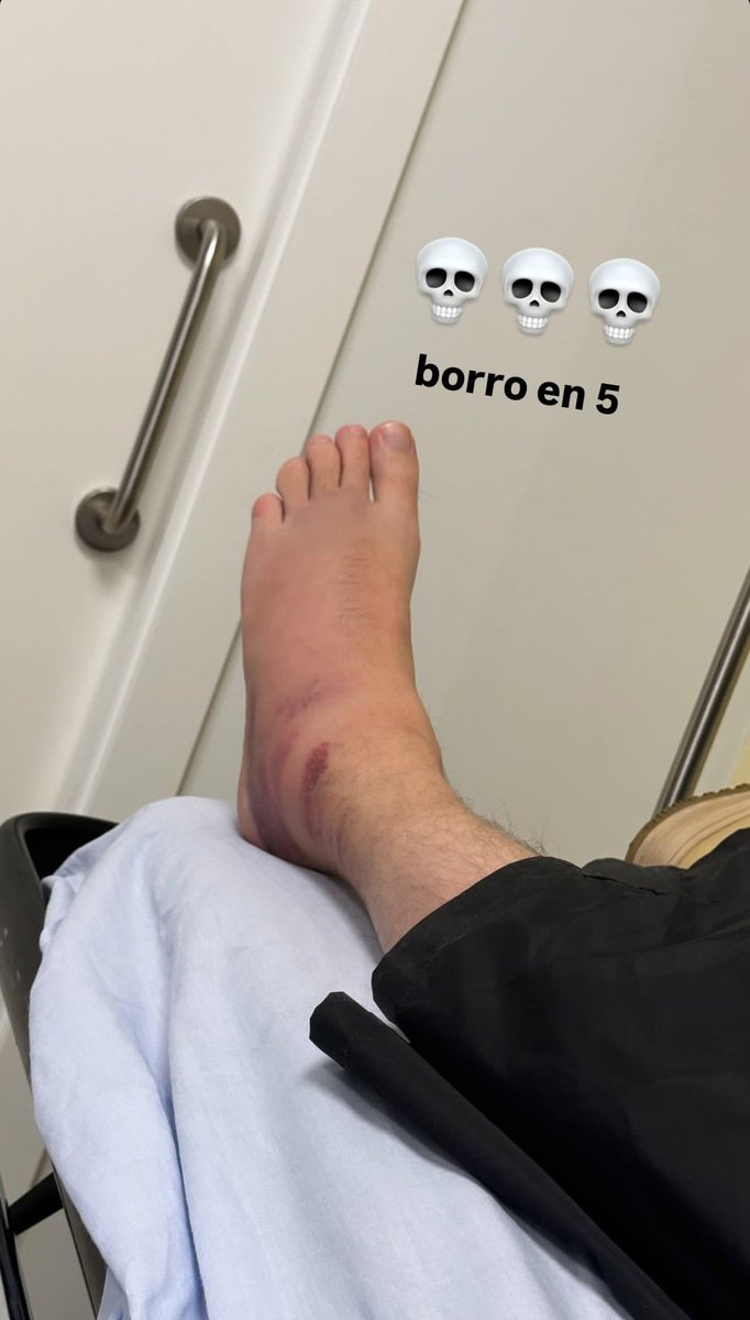 NanekoNya's tweet image. Más que verlo así ahora, que ya da impresión, pienso en cómo mierda actuó la adrenalina en su cuerpo para tanquear el eventazo, pasárselo de puta madre, irse de fiesta masónica y seguir existiendo con el pie en ese estado 😭😭