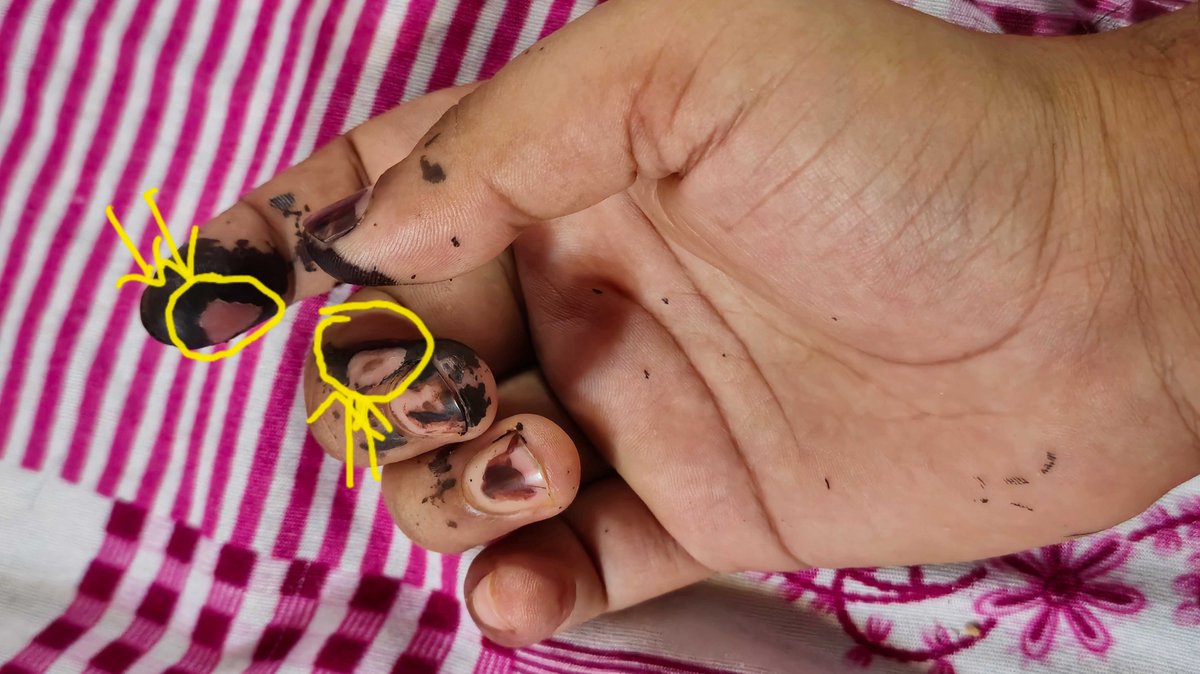 AseemManhas's tweet photo. (4/4)
I kindly request that the concerned authorities to take appropriate action to ensure that good-quality gloves are provided to polling officers in the future. Additionally, I suggest that instead of ink, a marker should be used
@ECISVEEP @CEO_Maharashtra @rajivkumarec https://t.co/PwOJDe45A2