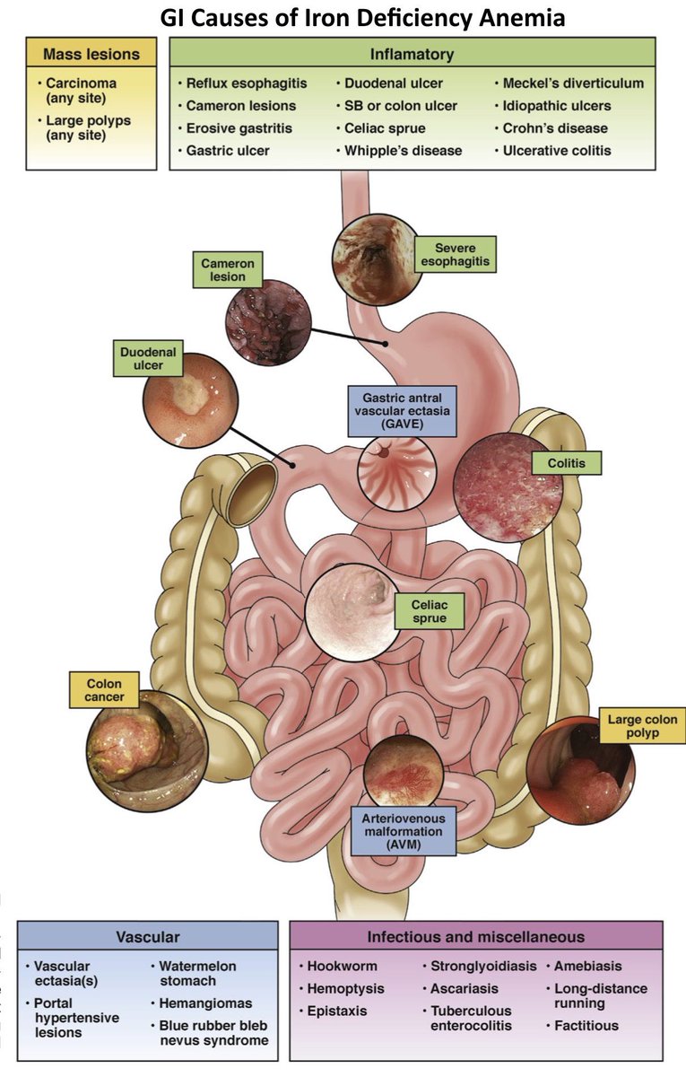 GI causes of iron deficiency anaemia 💡

📸: gastrojournal.org/action/showPdf…