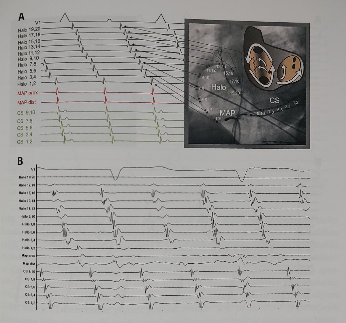 ABC of the flutter wave in typical counterclockwise (CCW) flutter. Then normal activation from a book by Czech EP experts and the last pic is their excellent depiction of CCW flutter. Since reentry has its head and tail plus direction there's a puppy video to show it for some ...