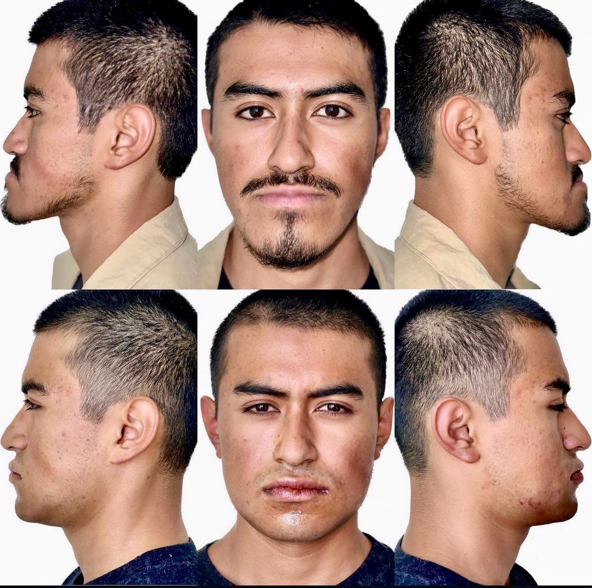 JesuCr91's tweet photo. La cirugía ortognática es un pilar en el campo de la cirugía maxilofacial, reestructuramos las bases óseas faciales corrigiendo desarmonías esqueléticas que afectan estética y función. Brindamos un enfoque quirúrgico preciso, mejorando tanto la mordida como el perfil facial. https://t.co/0lIi8bSC1z