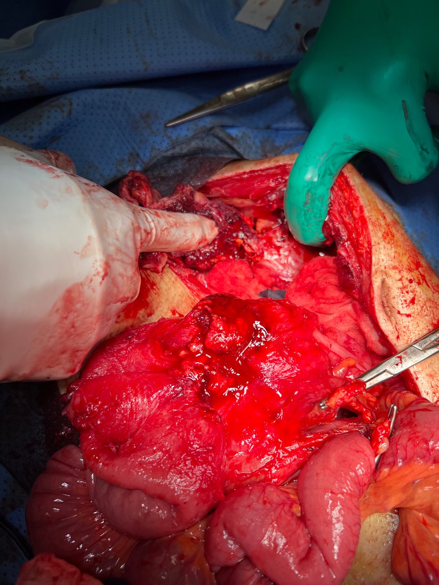 Weekend Oncall 
Crohns in a 19 year old
EnteroVesical Fistula
