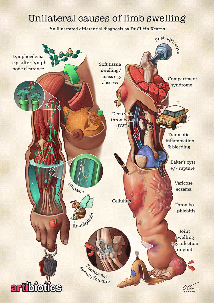 MoAImam's tweet photo. Causes of unilateral Limb swelling by
@artibiotics https://t.co/MaeKSEyihe