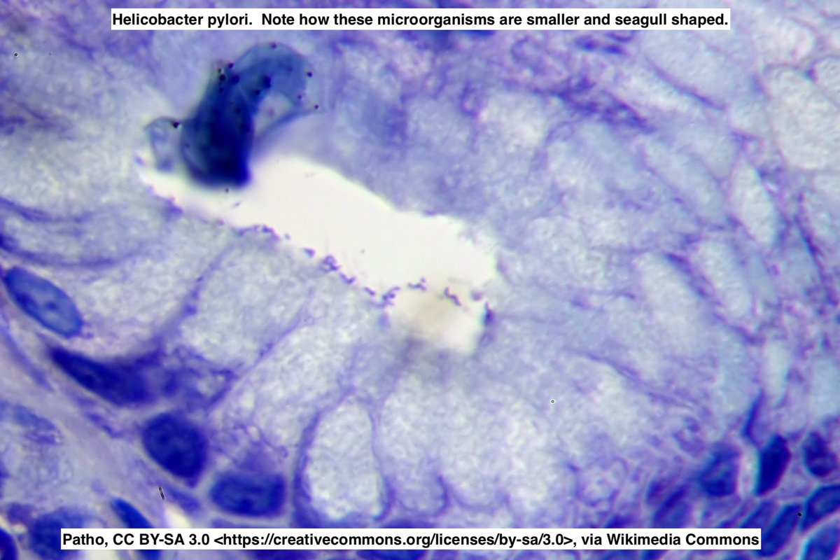 🦠Helicobacter heilmannii sensu lato (H. heilmanii s.l.)

📖Another Helicobacter species
🐷🐶🐱  Found in pigs, dogs, cats and humans
🔬Longer, "Corkscrew-like" bacteria compared to H. Pylori
⚠️Gastritis is milder w less lymphoid follicles and intestinal met than H. pylori #pathx