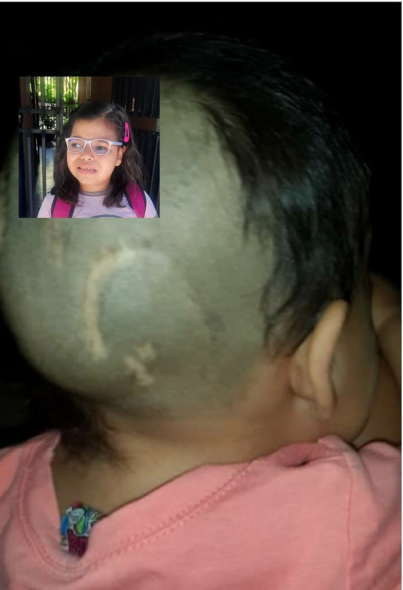 #URGENTE soy una niña de condición con muchas ganas de vivir con salud y sin limitaciones.
Necesito la ayuda económica para cubrir plan médico:
📍Tratamientos decapeptyl $450 y trileptal susp.
📍Consulta neuroirtopedista y oftalmologo $150
📍Terapias de rehabilitación
Gracias