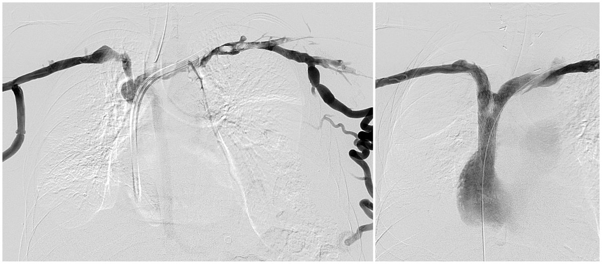 Jeffrey F. B. Chick, MD, MPH (@chickvir) on Twitter photo Upper extremity and thoracic central venous occlusive disease occurs in 15-20% of patients on dialysis and 30% in those with history of prior catheter placement. Dedicated venous stents may restore venous anatomy.
<a href="/CVIR_Journal/">CVIR Journal</a> <a href="/cvirendo/">CVIR Endovascular (Jim Reekers, Editor-in-Chief)</a> <a href="/JVIRmedia/">JVIR</a> <a href="/SIRspecialists/">Society of Interventional Radiology</a> <a href="/cirsesociety/">CIRSE</a> Upper extremity and thoracic central venous occlusive disease occurs in 15-20% of patients on dialysis and 30% in those with history of prior catheter placement. Dedicated venous stents may restore venous anatomy.
<a href="/CVIR_Journal/">CVIR Journal</a> <a href="/cvirendo/">CVIR Endovascular (Jim Reekers, Editor-in-Chief)</a> <a href="/JVIRmedia/">JVIR</a> <a href="/SIRspecialists/">Society of Interventional Radiology</a> <a href="/cirsesociety/">CIRSE</a>
