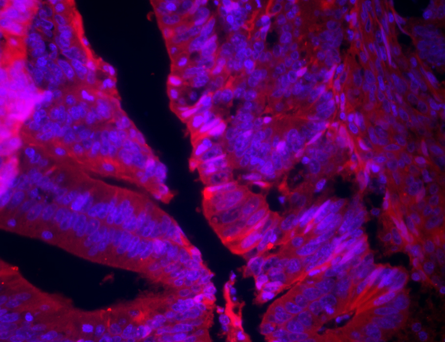 New research in Science #Immunology reports that oncogenic #KRAS promotes immune evasion in #colorectal cancer cells by increasing double stranded DNA degradation and inhibiting interferon responses. scim.ag/8p9
