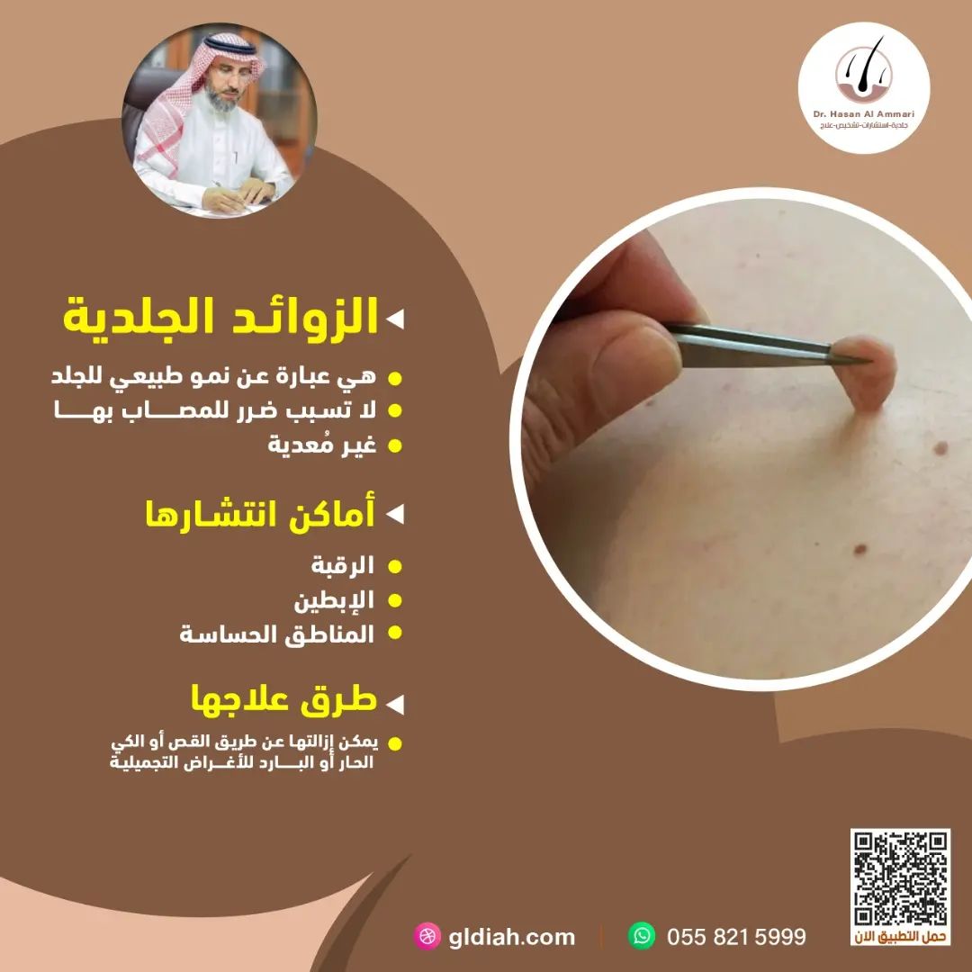 halammari1392's tweet photo. الزوائد الجلدية

- هي عبارة عن نمو طبيعي للجلد .
-لا تسبب ضرر للمصاب بها.
-غير مُعدية.

🔸 أماكن انتشارها 
- الرقبة .
-الإبطين .
-المناطق الحساسة.

 🔸 طرق علاجها 
- يمكن إزالتها عن طريق القص أو الكي الحار أو البارد للأغراض التجميلية .

 #زوائد_جلدية 
#مشكلات_جلدية 
#الهلال https://t.co/odvZsAz1qg