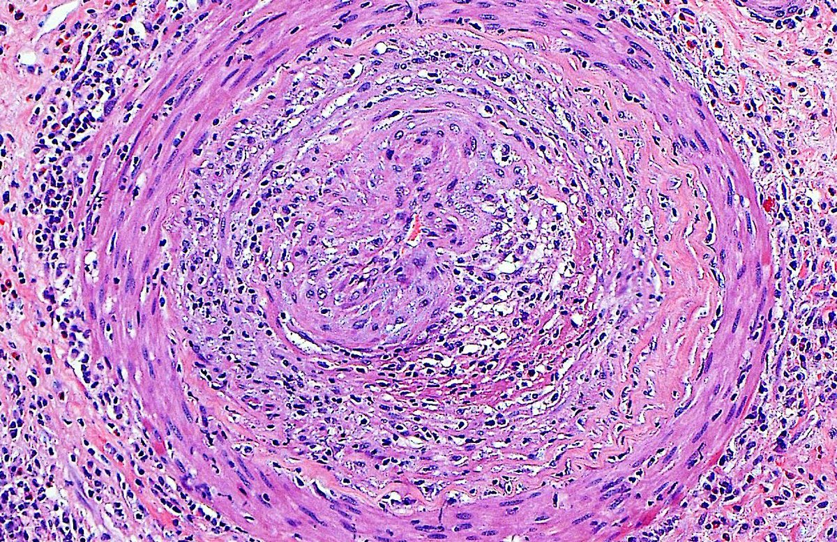 Ziad El-Zaatari (@ziad_zaatari) on Twitter photo Transplant Arteriopathy ~ In kidney with chronic rejection ➡️ Intimal thickening + inflammation in vessel wall ~ #RenalPath #Transplant #Kidney Transplant Arteriopathy ~ In kidney with chronic rejection ➡️ Intimal thickening + inflammation in vessel wall ~ #RenalPath #Transplant #Kidney