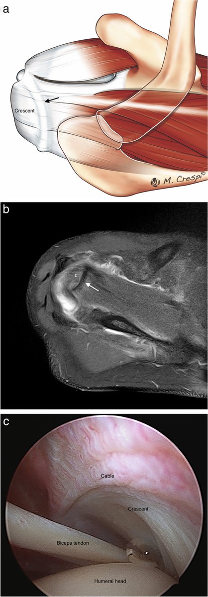 Rheumatology's tweet photo. Rotator cuff tear patterns: MRI appearance and its surgical relevance

A MUST READ

https://t.co/sM2FX1cdpd https://t.co/fRPO4wMG4a
