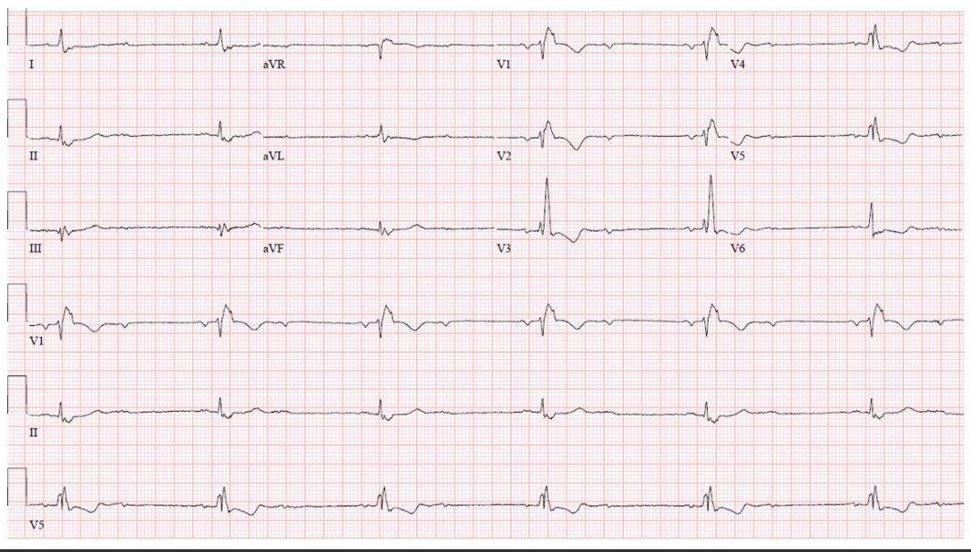HRS_CaseReports's tweet image. A Long-Distance Relationship: A Case Report of Extreme Mobitz Type Ihttps://www.heartrhythmcasereports.com/article/S2214-0271(24)00178-7/fulltext