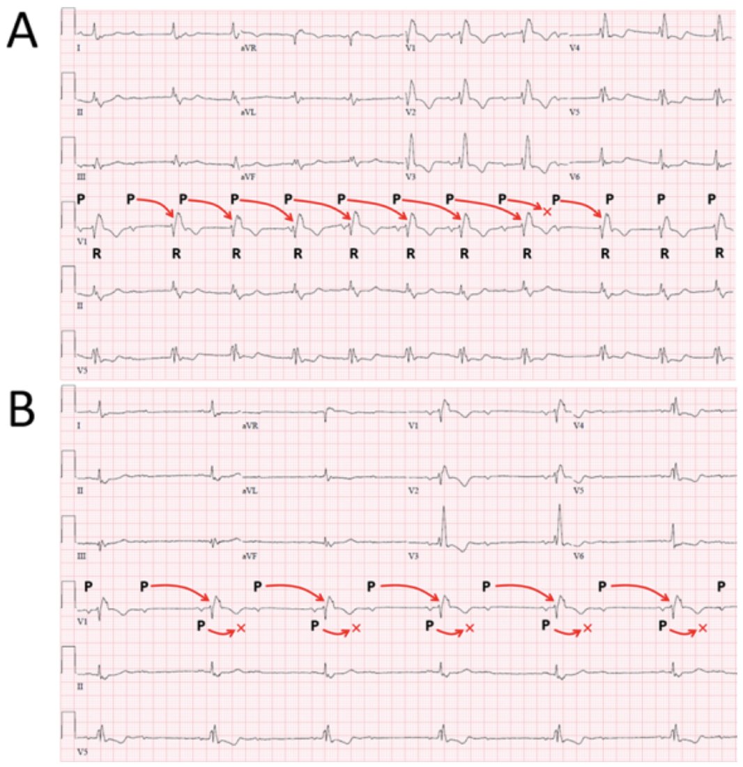 HRS_CaseReports's tweet image. A Long-Distance Relationship: A Case Report of Extreme Mobitz Type Ihttps://www.heartrhythmcasereports.com/article/S2214-0271(24)00178-7/fulltext