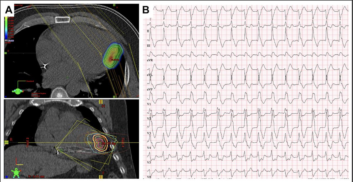 Heart Rhythm Case Reports tweet media