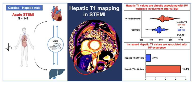 Luca Bergamaschi (@l_bergamaschi) on Twitter photo "Hepatic T1 mapping has emerged as a novel imaging biomarker of the cardio-hepatic axis in STEMI, being associated with RV involvement and increased NT-proBNP" doi.org/10.1093/ehjci/…
Thanks to <a href="/AnnaGiuliaPavon/">Anna Giulia Pavon</a> for the leadership and to the whole Team!
#whyCMR #CVimaging "Hepatic T1 mapping has emerged as a novel imaging biomarker of the cardio-hepatic axis in STEMI, being associated with RV involvement and increased NT-proBNP" doi.org/10.1093/ehjci/…
Thanks to <a href="/AnnaGiuliaPavon/">Anna Giulia Pavon</a> for the leadership and to the whole Team!
#whyCMR #CVimaging