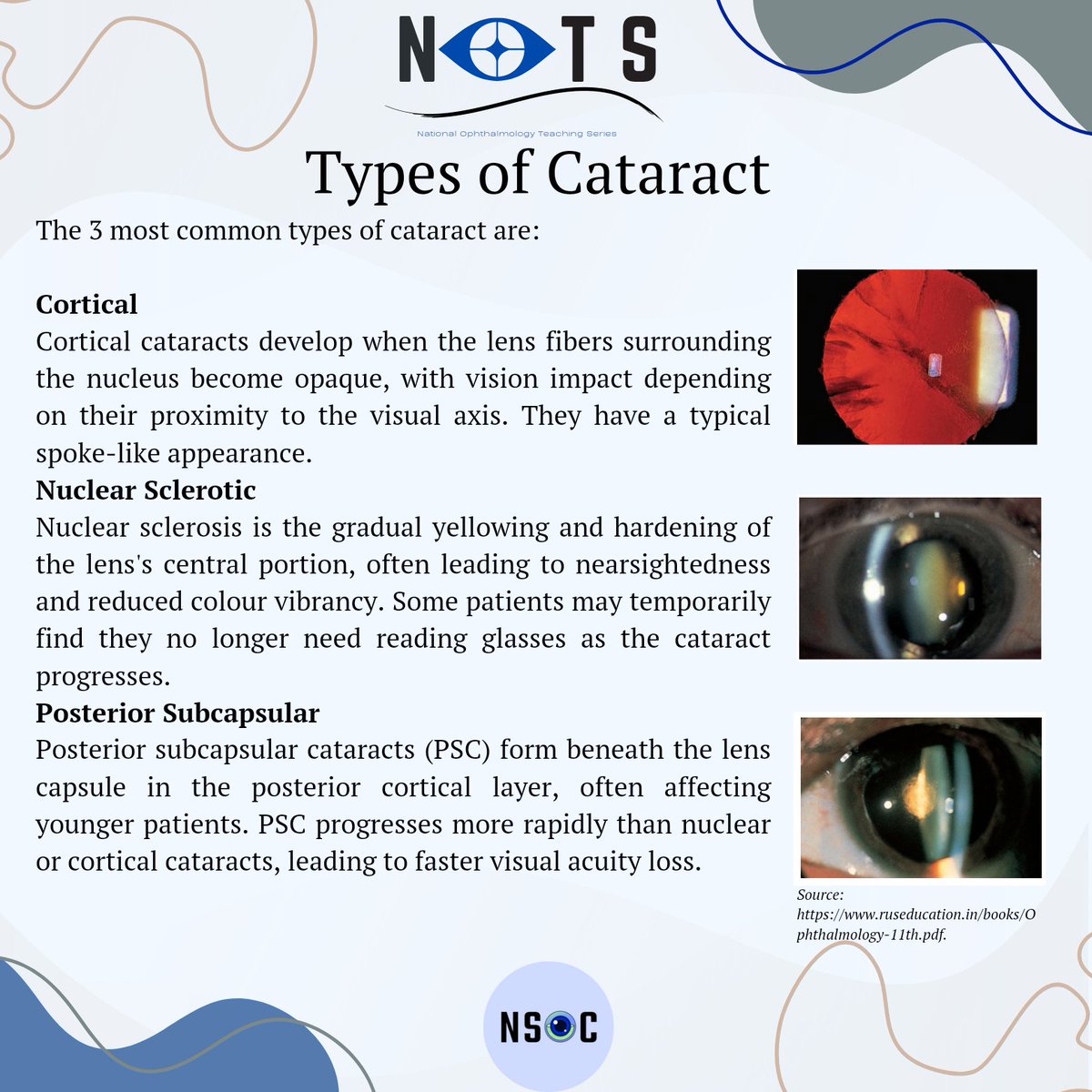 NatOphthalTeach's tweet photo. We are back with another of our fact sheets, this time on cataracts, which is still unfortunately one of the leading causes of blindness in the developing world. 

Keep a look out for our fact sheets which will be posted every 2 weeks ☺️

Author: Amelia Rees https://t.co/rrUd31KEzw