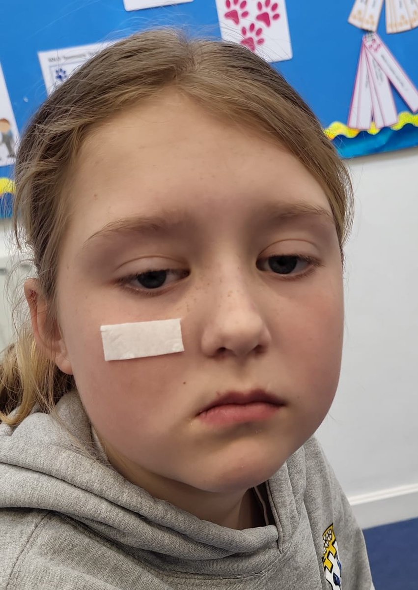 MILLERCC1's tweet photo. much pain. As well as pain,she has to cope with the side effects of her meds. There are so few children affected by TN,there's little to no research being done to find treatments etc,fingers crossed we are helping to change that #faceofTN
#showTN3fingers #talksharemakeothersaware https://t.co/doCDi6X2cr