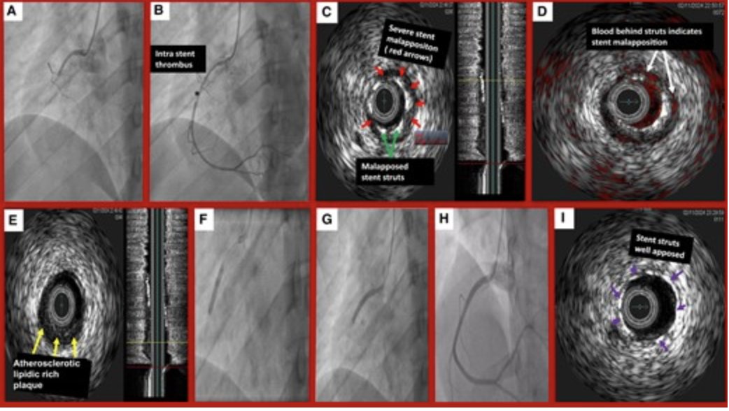 ESC_Journals's tweet photo. Early stent thrombosis: does it still happen? https://t.co/m27sxTYaAN

#EHJCaseReports @Phiso_de @TJ_Yeo @aayshacader @BoldiKovacsMD @KardiologieHH @ANazmiCalik @O_Azizy_MD @saramoscatelli7 @EHJCREiC #CardioX https://t.co/FDvkyab6jA