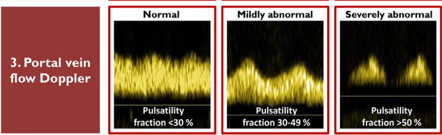 EmergPOCUS's tweet photo. 🫡 #Doppler de la Vena #Porta en el Protocolo #VExUS 🩺📊

•#Patrones de flujo en la vena porta 🌊🧬:
•Se evalúan las #variaciones de las velocidades de flujo durante un ciclo cardíaco completo ❤️💙.
•Se mide la velocidad máxima (#peak) 📈 y la velocidad mínima (#nadir) 📉 en la onda Doppler de la vena porta.

•#Fracción_de_Pulsatilidad_de_la_Vena_Porta 📊🌀:
•Se calcula con la #fórmula:
[(vel max – vel min) / vel max] × 100 🤓

• #Interpretación de la Fracción de Pulsatilidad 🔍📊:

•<30%: Considerado normal 👍✅
•30% a 49%: Considerado levemente anormal ⚠️🔶
•≥50%: Considerado severamente anormal 🚨🔴

#VExUS #DopplerVenaPorta #EcografíaCrítica #Ultrasonido #POCUS #MedicinaDeUrgencias 🚑📡

https://t.co/kxKFQ46QqP