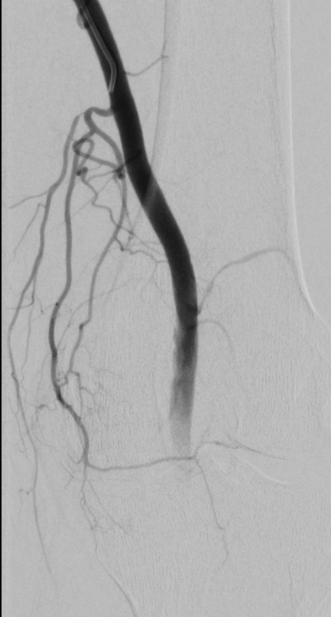 Michael Cumming (@drmcumming) on Twitter photo GAE - interesting variant - looks like the superomedial genicular artery is arising the the descending GA as a variant. Haven't run into this before. GAE - interesting variant - looks like the superomedial genicular artery is arising the the descending GA as a variant. Haven't run into this before.