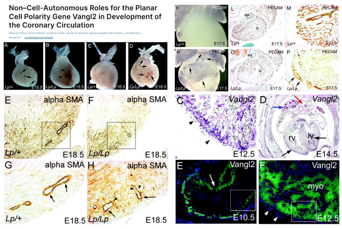 HaoYin20's tweet image. Vangl2 #PlanarCellPolarity in Coronary vascularization🫀

Vangl2 lp/lp🐭
1⃣Ectopic, dilated, tortuous coronary vessels e13.5 ~18.5
2⃣Unaltered epicardial differentiation (WT1, RALDH2), but +diminished Fibronectin deposit e13.5 +flattened epicardium +⏬epicardial EMT/inward…