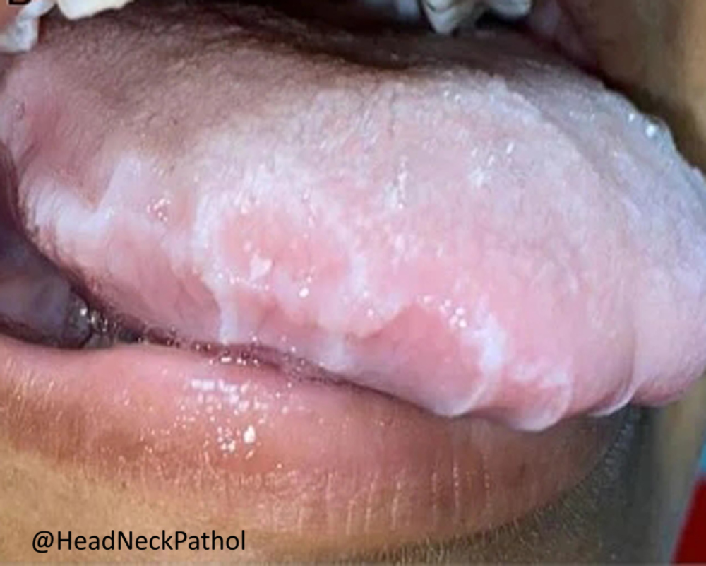 HeadandNeckPath's tweet photo. Uremic Stomatitis: A Latin American Case Series and Literature Review
By José Alcides Almeida de Arruda, João Luiz Gomes Carneiro Monteiro, et al 
https://t.co/AZXwegJzyo
#HeadNeckPathol #HNPJ #HeadandNeckPath #Pathology #ENTPath #PathologyTweet https://t.co/bysK9Xn9rI