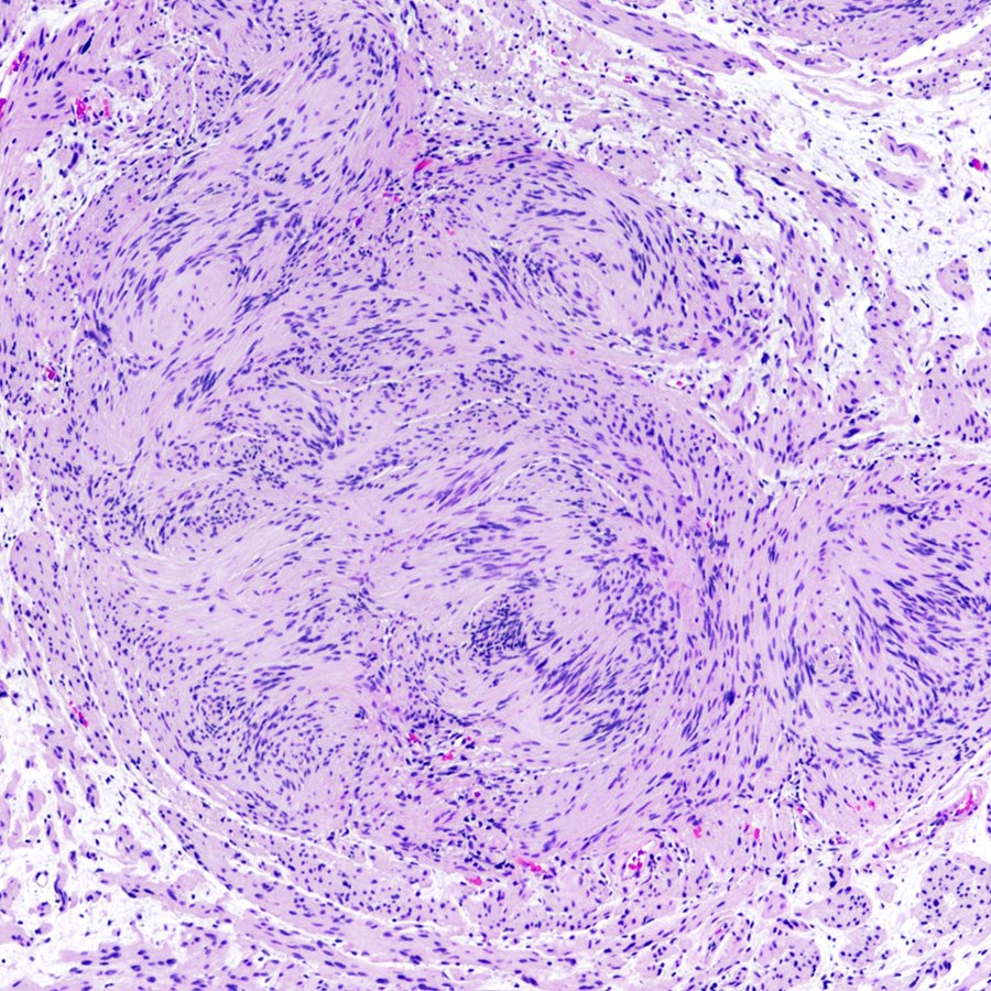 Here's a great chance to PLEX your #neuropath muscles and diagnose this neck mass in an NF2 patient. #pathology #PathTwitter