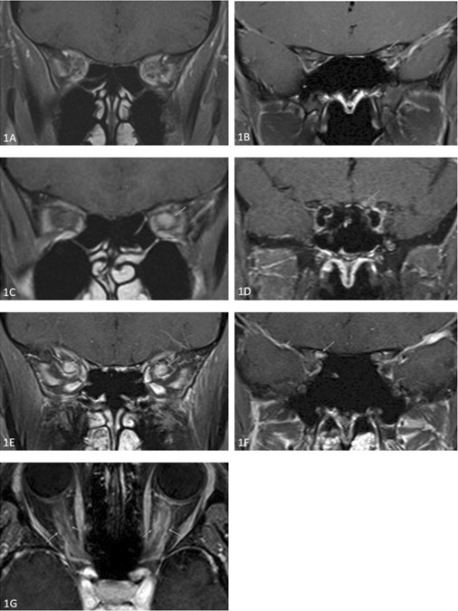 Ophthalmology (@aaojournal) on Twitter photo Retrospective study of 129 eyes of 92 patients w/ first time MOGAD #OpticNeuritis: eyes w/ only mild optic nerve enhancement were more likely to have poor VA outcome (OR 8.57), incomplete VA recovery (OR 7.31), and poor VF outcome (OR 6.81) <a href="/UofT/">University of Toronto</a>
ow.ly/BxWY50Te8GO Retrospective study of 129 eyes of 92 patients w/ first time MOGAD #OpticNeuritis: eyes w/ only mild optic nerve enhancement were more likely to have poor VA outcome (OR 8.57), incomplete VA recovery (OR 7.31), and poor VF outcome (OR 6.81) <a href="/UofT/">University of Toronto</a>
ow.ly/BxWY50Te8GO