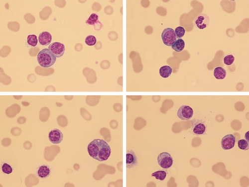Lymphoplasmacytoid cytology in plasma cell leukemia
|American Journal of Hematology | Blood Research Journal | Wiley Online Library onlinelibrary.wiley.com/doi/full/10.10…