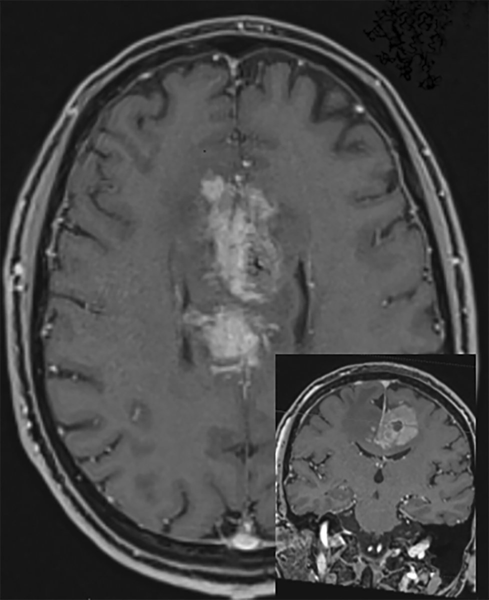 Brain Pathology tweet media