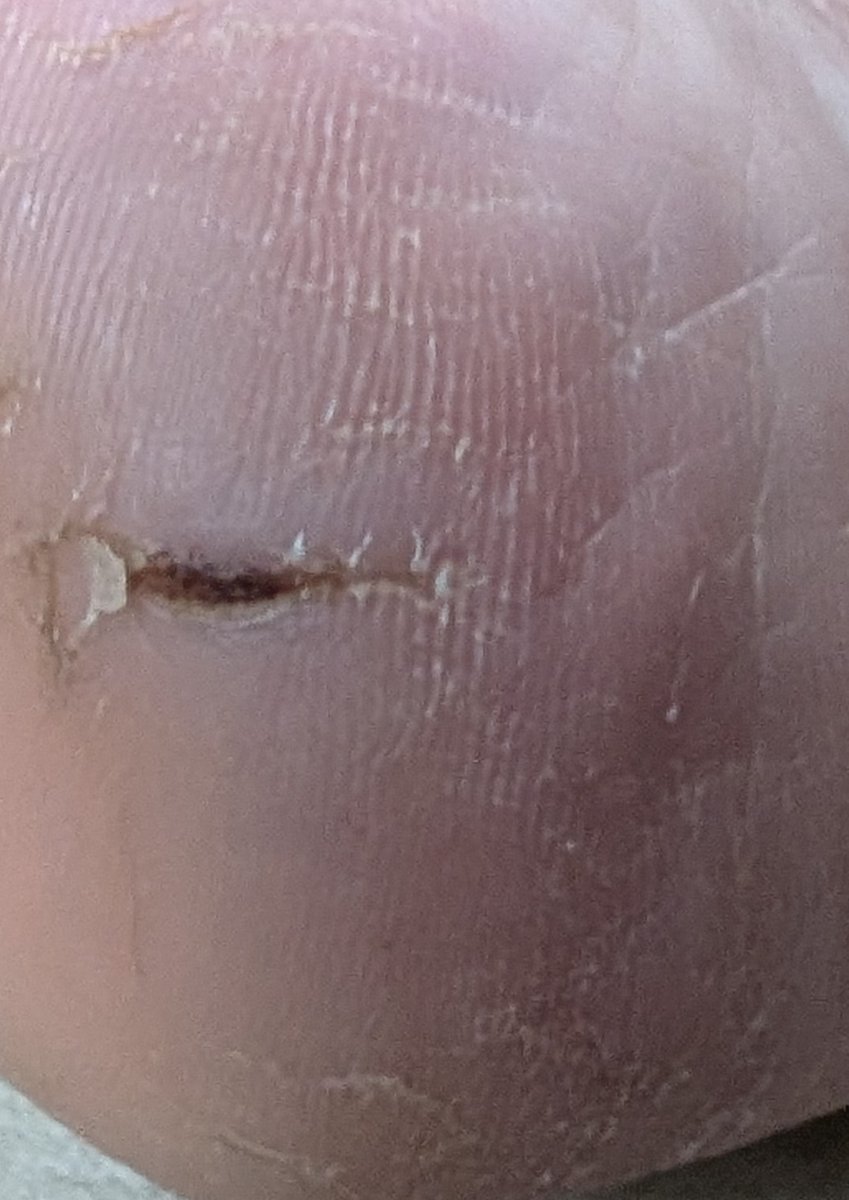 JimmyParker87's tweet image. This is a heel split. Very painful. Any advice on how to deal with these? I've tried everything that I can think of. #AskTwitter