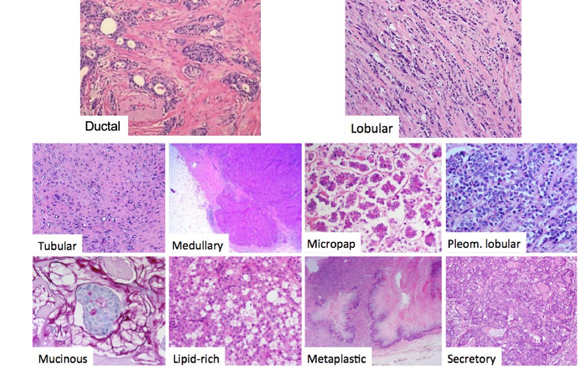 Molecular Breast Pathology Lab (@breast_lab) on Twitter photo Did you know there are ~20 different histological subtypes of #breastcancer? 
We focus on investigating rare subtypes #lobular & #metaplastic #breastcancer, digging deep into their unique biology to improve treatment outcomes!🧬🔬
 
#BreastCancerAwarenessMonth #UQCCR #Pathology Did you know there are ~20 different histological subtypes of #breastcancer? 
We focus on investigating rare subtypes #lobular & #metaplastic #breastcancer, digging deep into their unique biology to improve treatment outcomes!🧬🔬
 
#BreastCancerAwarenessMonth #UQCCR #Pathology