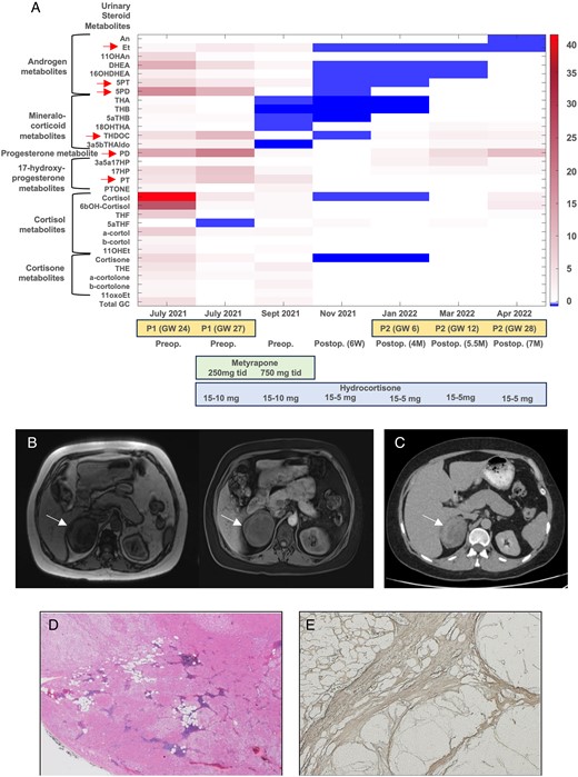 Euro J Endocrinology (@ejendo) on Twitter photo Primary unilateral macronodular adrenal hyperplasia with concomitant glucocorticoid and androgen excess and KDM1A inactivation by <a href="/Yasir_SElhassan/">Yasir Elhassan</a> <a href="/CryRonchi/">Cristina Ronchi</a> @WiebkeArlt et al
EJE Volume 191, Issue 3, September 2024
Open access paper 👉 doi.org/10.1093/ejendo…
#cushings Primary unilateral macronodular adrenal hyperplasia with concomitant glucocorticoid and androgen excess and KDM1A inactivation by <a href="/Yasir_SElhassan/">Yasir Elhassan</a> <a href="/CryRonchi/">Cristina Ronchi</a> @WiebkeArlt et al
EJE Volume 191, Issue 3, September 2024
Open access paper 👉 doi.org/10.1093/ejendo…
#cushings