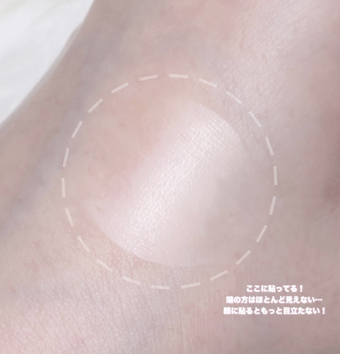 ニキビ跡やレーザー治療後のケアに最適なフィルモアって知ってる❔卵の薄皮の約1/10程の薄さのフィルムなのにUVカット率約97%❕「塗る」のではなく「貼る」から物理的な刺激も少なく済むし、貼ってる間はずっとUVカット＆刺激をブロックしてくれるの助かる……#PR