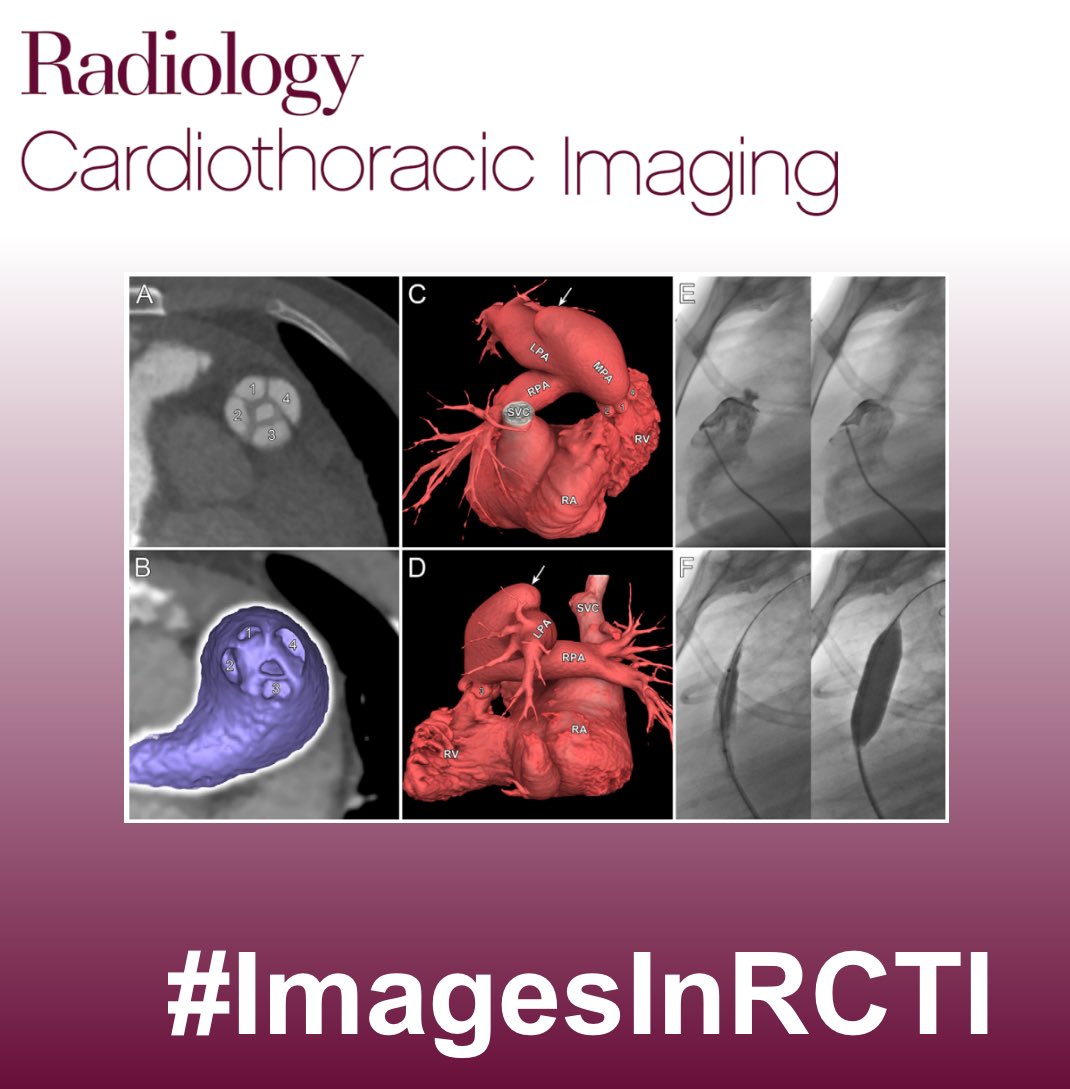 Roberta Catania (@robi_catania) on Twitter photo 🚨 Ready to test your skills again? 🚨
57-years-old male with progressive worsening scrotal edema.
Findings? Diagnosis?
#InTrainingRCTI #ImagesInRCTI <a href="/RadiologyCTI/">Radiology: Cardiothoracic Imaging</a> 🚨 Ready to test your skills again? 🚨
57-years-old male with progressive worsening scrotal edema.
Findings? Diagnosis?
#InTrainingRCTI #ImagesInRCTI <a href="/RadiologyCTI/">Radiology: Cardiothoracic Imaging</a>