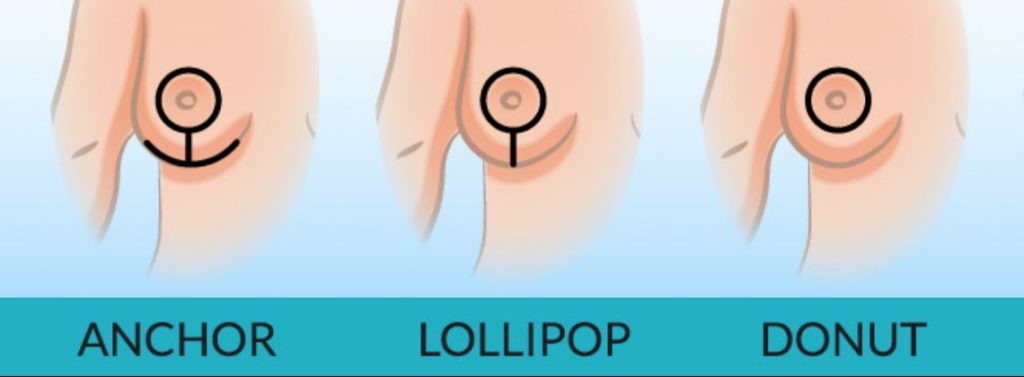 ✨ Breast Lift incision options based on your needs:
🔹 Donut: Minimal scarring for subtle lifts
🔹 Lollipop: Great for moderate sagging
🔹 Anchor: Ideal for significant reshaping
 LEARN MORE: i.mtr.cool/rhlojxqrir