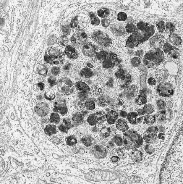 The Neuro (@theneuro_mni) on Twitter photo A study from Peter McPherson's lab has recreated the growth of Lewy bodies in human neurons and followed their formation to gain important insight into why and how they form, finding that immune challenge is important for this process.
💡 mcgill.ca/neuro/channels…
<a href="/ScienceofPD/">The Science of Parkinson's</a> A study from Peter McPherson's lab has recreated the growth of Lewy bodies in human neurons and followed their formation to gain important insight into why and how they form, finding that immune challenge is important for this process.
💡 mcgill.ca/neuro/channels…
<a href="/ScienceofPD/">The Science of Parkinson's</a>