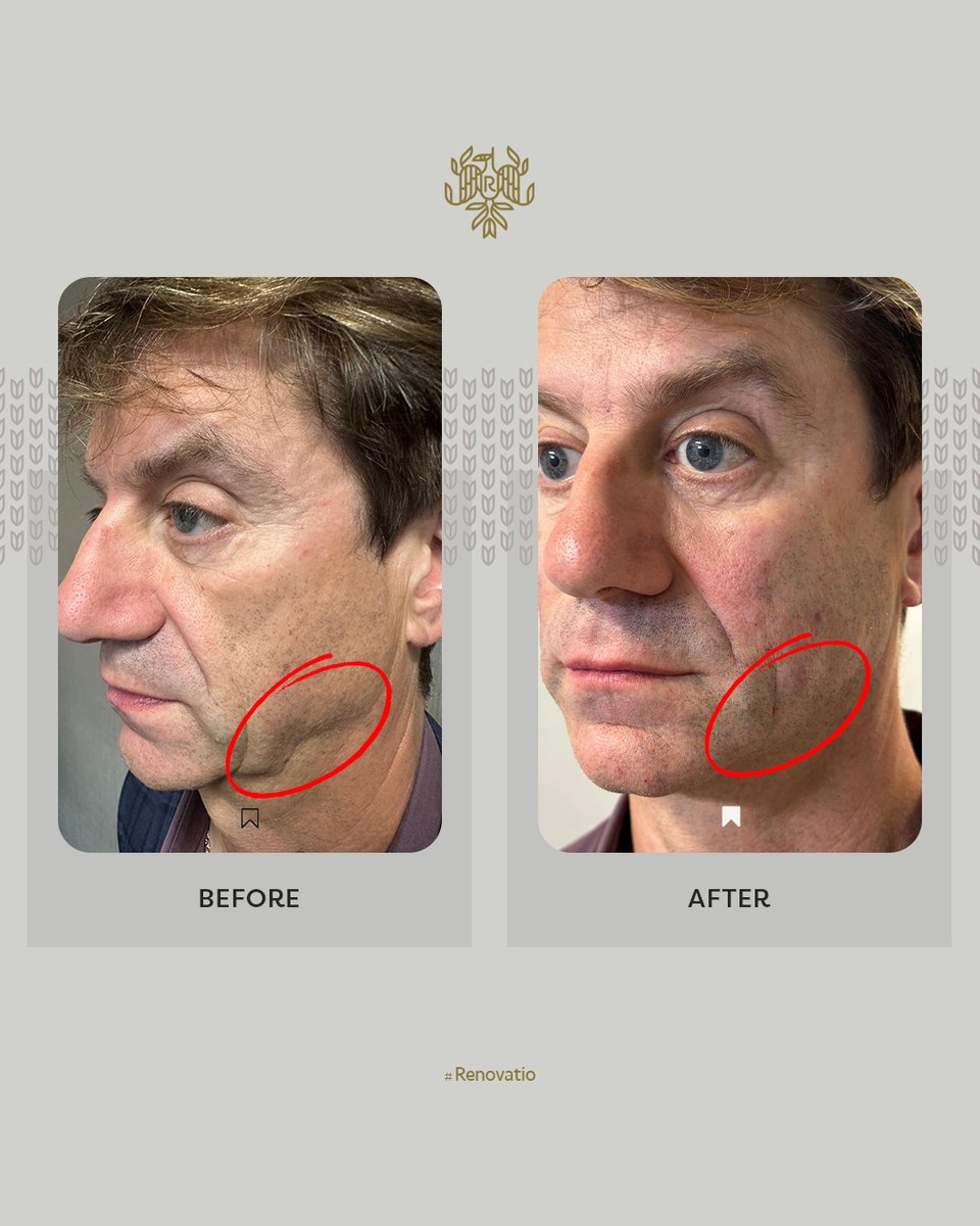 Jawline transformation! ✨ This before and after shows the incredible difference that fillers can make for jawline profile balancing.
By enhancing definition and symmetry, we’re able to achieve a more structured and youthful look—without surgery! 💉