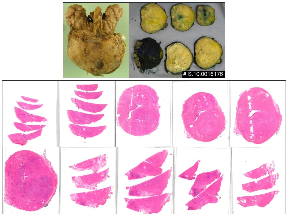 Why is prostate sampling so unique? Radical prostatectomies are the only resection specimens  routinely submitted in total for histological examination with significant workload implications for pathologists and laboratories. Is this really necessary?