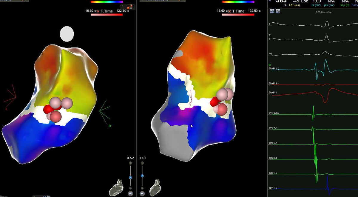 Salman Ghazni, MBBS, FCPS Cardiology, DRCPSC EP tweet media