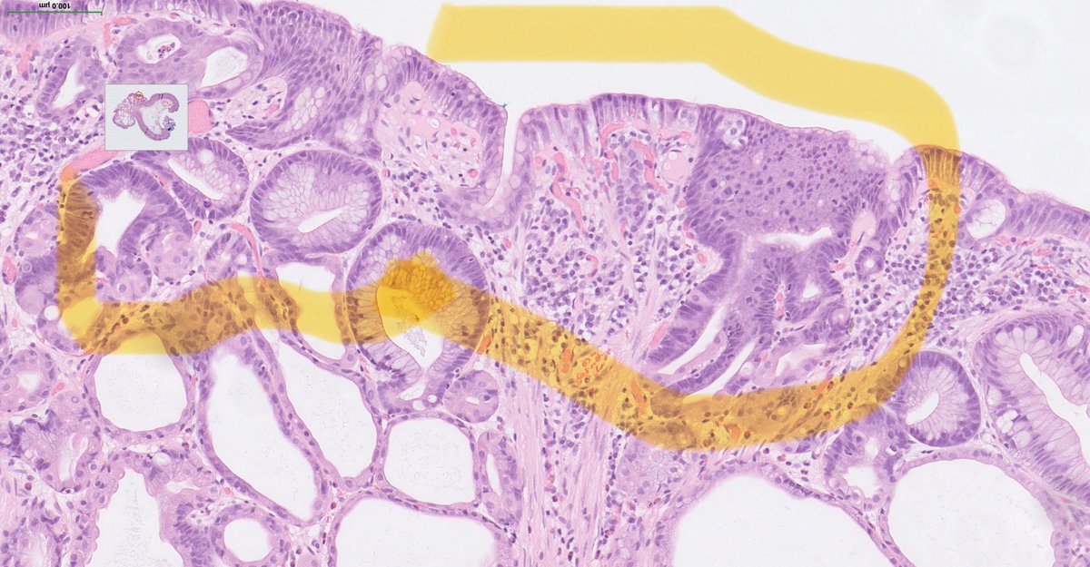 drtimbracey's tweet image. Gastric fundic gland polyp excised after a prior biopsy diagnosis of low grade dysplasia. Foci of LGD marked, and arrows showing “apocrine-like” cytoplasmic snouts seen in patients on PPI medication #pathtwitter #GIPath #pathart @diagnexia
